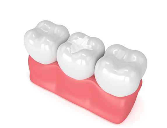 What Are Composite Fillings