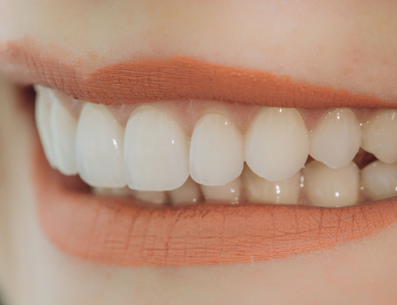 Who Is A Good Candidate For Porcelain Veneers