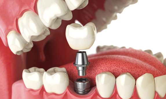 Why Are Dental Implants Needed