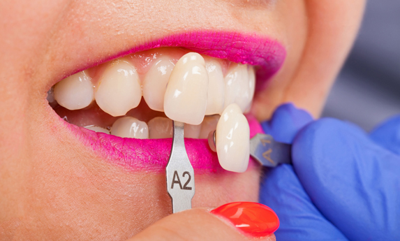 Why Are Porcelain Veneers Needed
