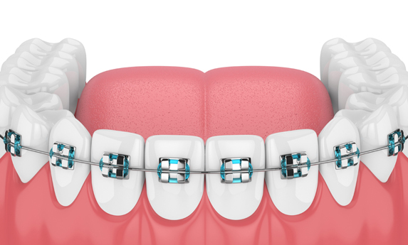 Why Is Orthodontic Treatment Needed