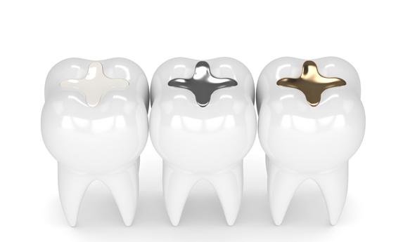 Why Would Composite Fillings Be Needed