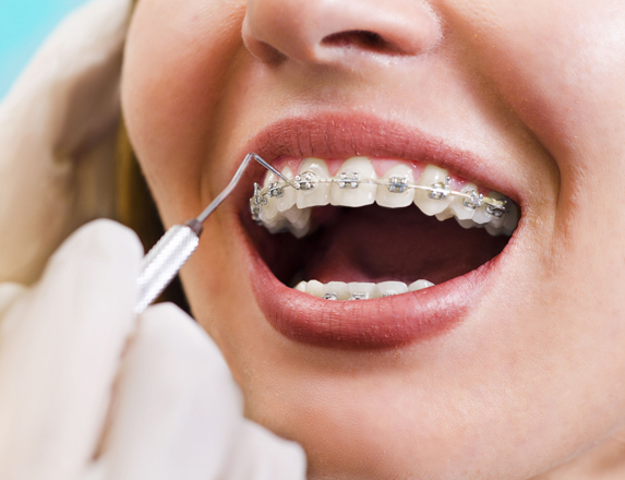 Good Candidate For Orthodontic Treatment