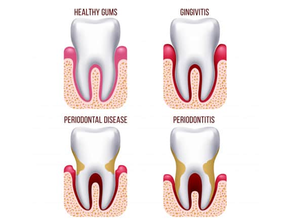 what is periodontal disease 1 min