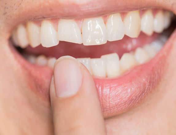 what is a cracked tooth min